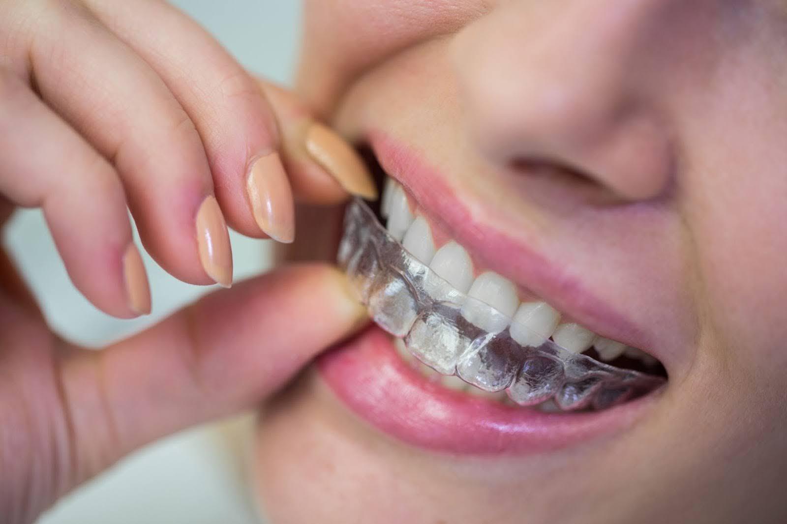 Invisalign treatment at Smiling Molar Dental Plainfield